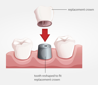 Image of the parts of a dental crown.