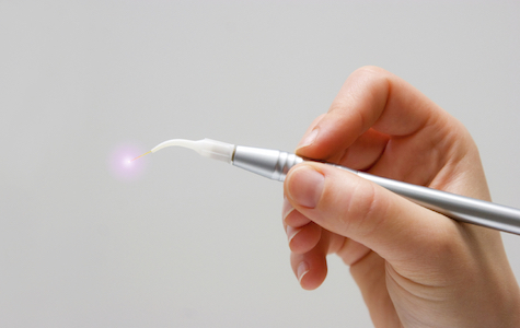 Hand holding the wand which is a common tool for laser dentistry procedures at Chris Johns, DDS in Millbrae, CA.