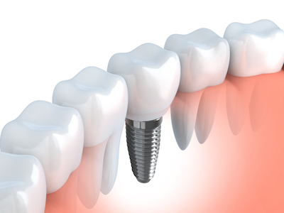 3D image of dental implants and how they fit in between healthy teeth.